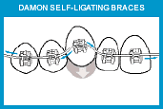 damon self-ligating braces